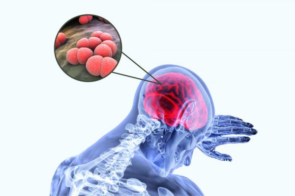 Meningite: tudo o que necessita saber sobre a meningite